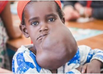 Negalem lethal facial tumor Dr. Teresa O Dr. Milton Waner