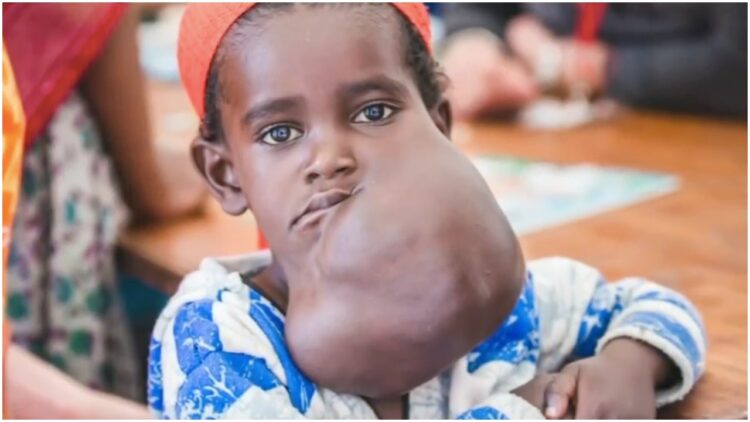 Negalem lethal facial tumor Dr. Teresa O Dr. Milton Waner