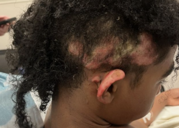 Virginia, burn victim, middle school, Ronica Wilson, Henrico County, fire, middle school