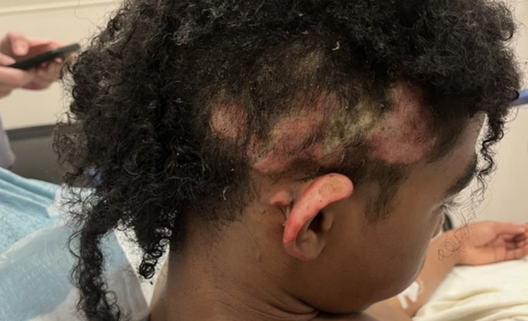 Virginia, burn victim, middle school, Ronica Wilson, Henrico County, fire, middle school