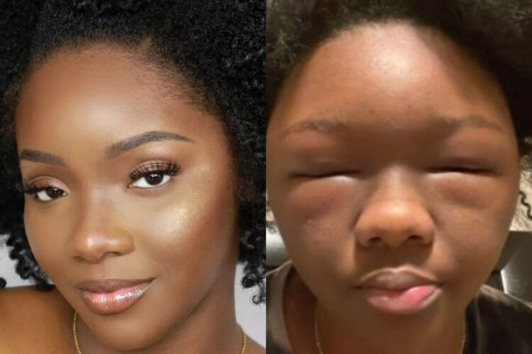 Hair Dye Causes Texas Woman To Have An Allergic Reaction, Disabling Her